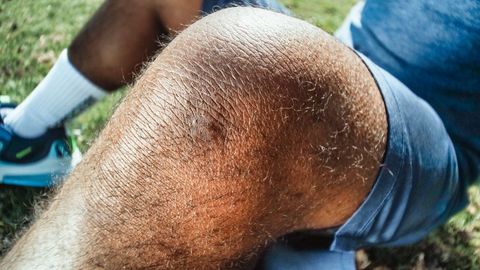 Back of Knee Swells After Standing